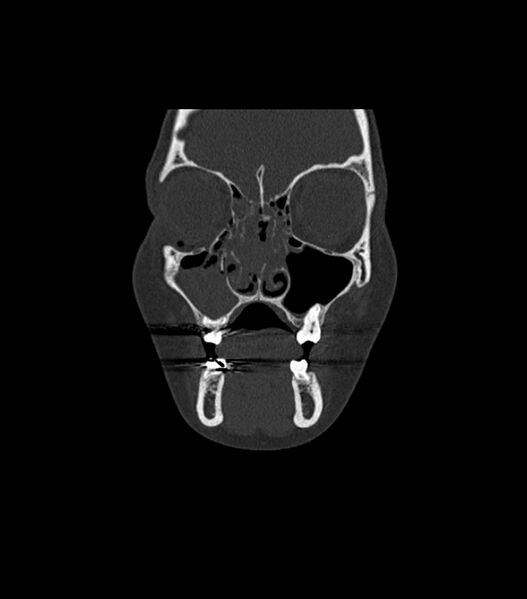 File:Nasoorbitoethmoid fracture (Radiopaedia 90044-107205 Coronal bone window 41).jpg