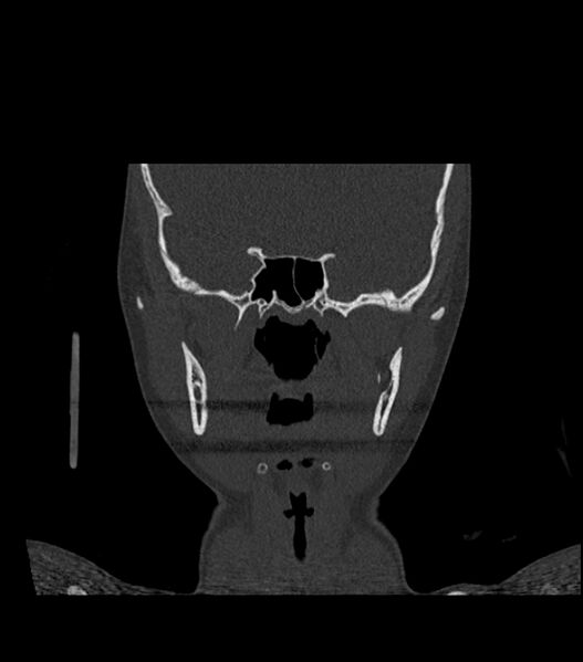 File:Nasoorbitoethmoid fracture (Radiopaedia 90044-107205 Coronal bone window 75).jpg