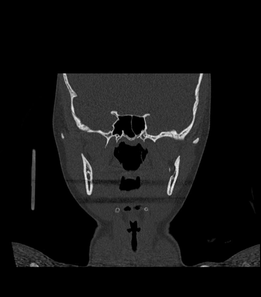 Nasoorbitoethmoid fracture (Radiopaedia 90044-107205 Coronal bone window 75).jpg