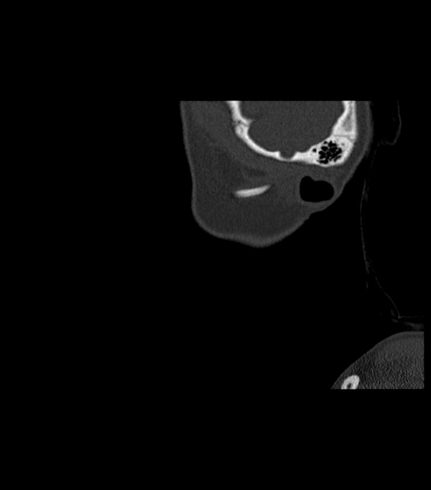 Nasoorbitoethmoid fracture (Radiopaedia 90044-107205 Sagittal bone window 132).jpg