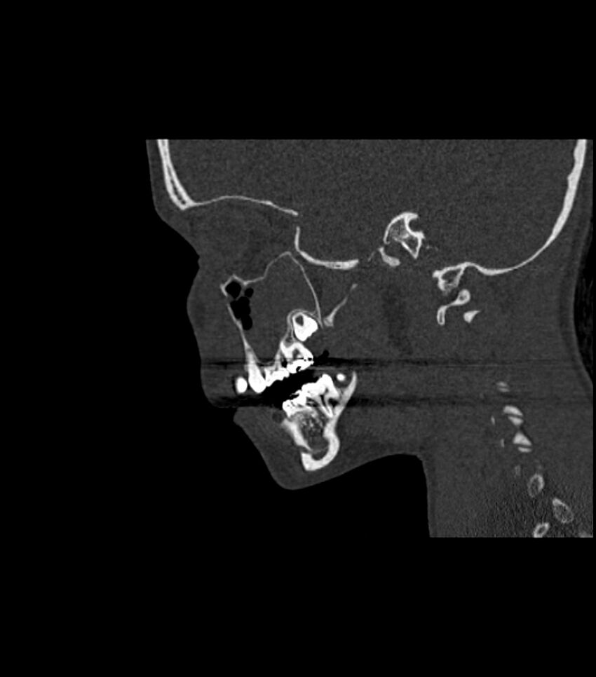 Nasoorbitoethmoid fracture (Radiopaedia 90044-107205 Sagittal bone window 96).jpg