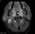 Nasopharyngeal carcinoma (Radiopaedia 4546-6667 Axial T1 C+ fat sat 15).jpg