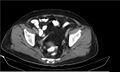 Necrotizing pancreatitis (Radiopaedia 20595-20495 Axial C+ delayed 40).jpg