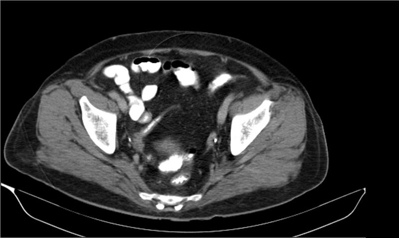 File:Necrotizing pancreatitis (Radiopaedia 20595-20495 Axial C+ delayed 40).jpg