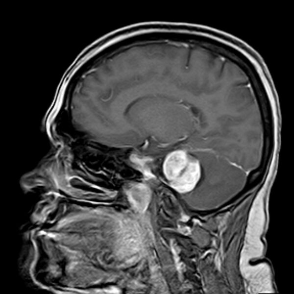 File:Neurofibromatosis type 2 (Radiopaedia 67470-76871 Sagittal T1 C+ 11).jpg