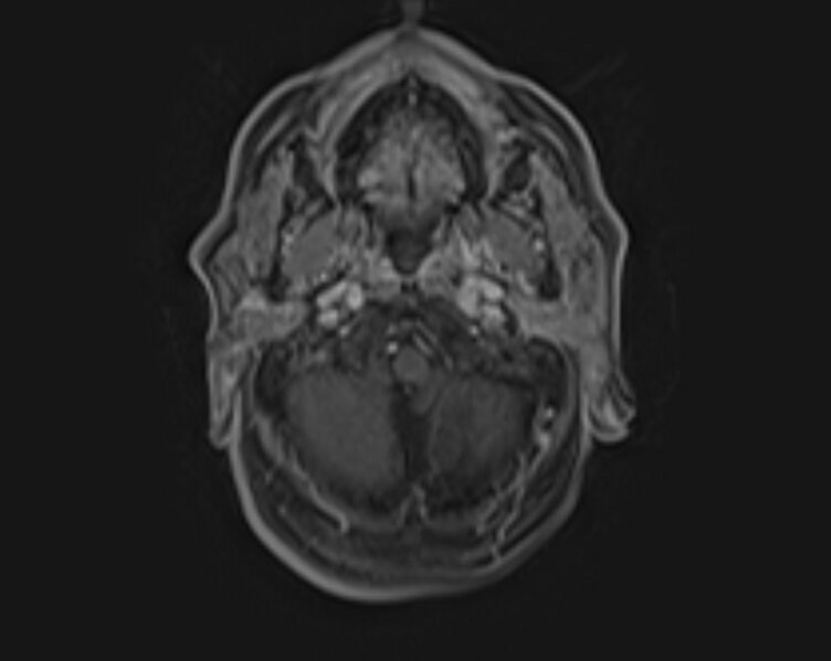 File:Non-Hodgkin lymphoma - parotid gland (Radiopaedia 71531-81890 E 42).jpg