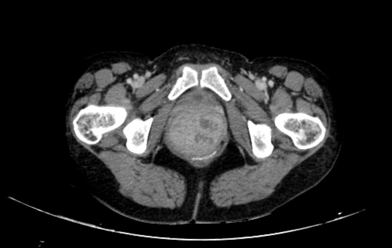 File:Non-puerperal uterine inversion (Radiopaedia 78343-91094 A 86).jpg