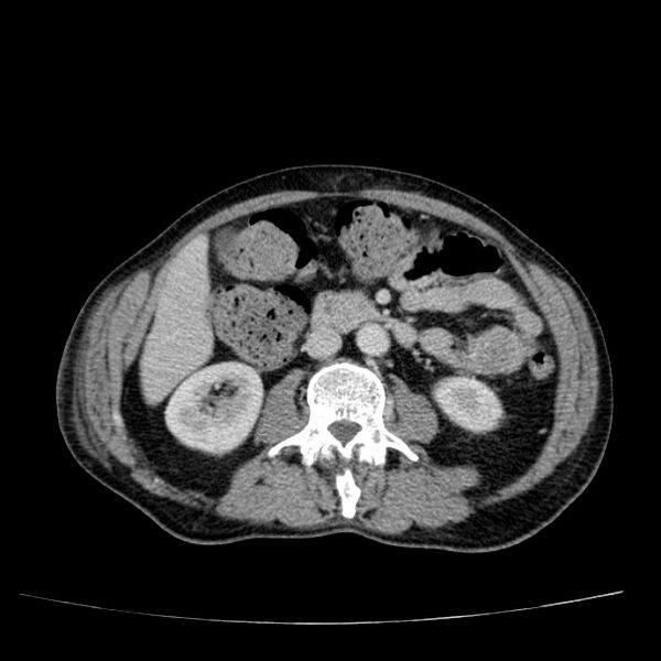 File:Non small-cell lung cancer (Radiopaedia 24467-24769 C+ delayed 78).jpg