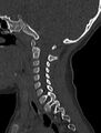 Normal CT cervical spine - pediatric (Radiopaedia 52549-58462 Sagittal bone window 139).jpg