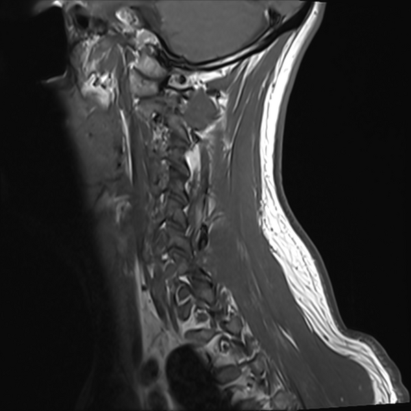 File:Normal MRI cervical spine (infection protocol) (Radiopaedia 53916-60039 Sagittal T1 14).png