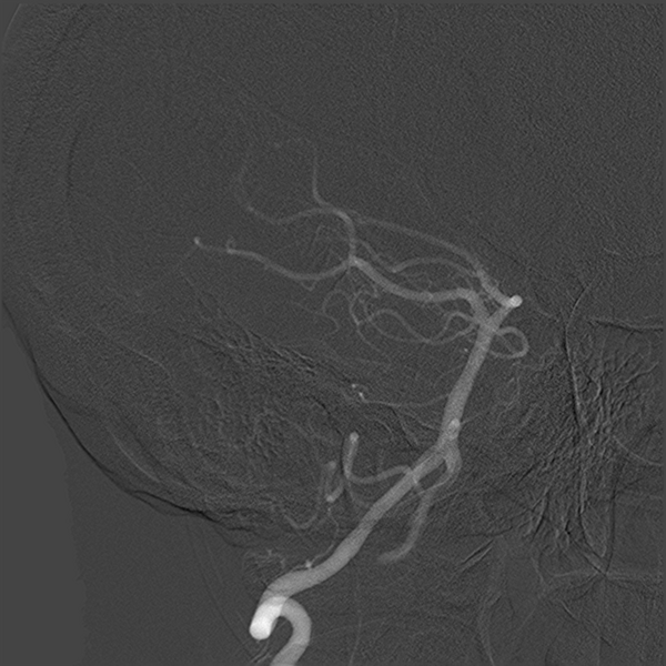 File:Normal cerebral angiogram (four vessel DSA) (Radiopaedia 41708-44649 O 7).png