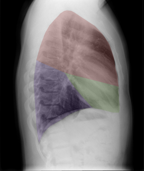 File:Normal chest x-ray - lobes (illustration) (Radiopaedia 58938-66192 Lateral 1).png