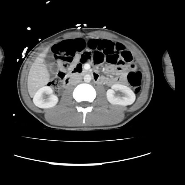 File:Normal dual-phase trauma CT chest,abdomen and pelvis (Radiopaedia 48092-52899 A 68).jpg