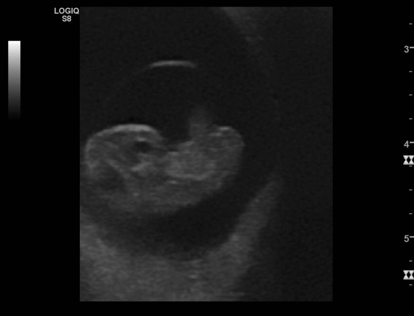 Normal early pregnancy - 8w0d (Radiopaedia 44715-48492 Longitudinal 73).jpg