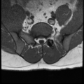 Normal lumbar spine MRI (Radiopaedia 35543-37039 Axial T1 6).png