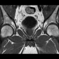 Normal prostate (MRI) (Radiopaedia 29986-30535 Coronal T1 8).jpg