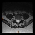 Normal spine MRI (Radiopaedia 77323-89408 Axial T2 21).jpg