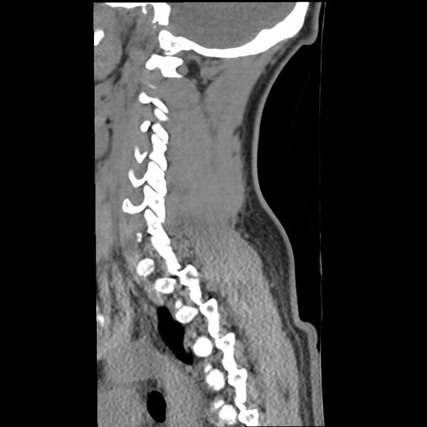 File:Normal trauma spine imaging (Radiopaedia 31753-32686 A 32).jpg