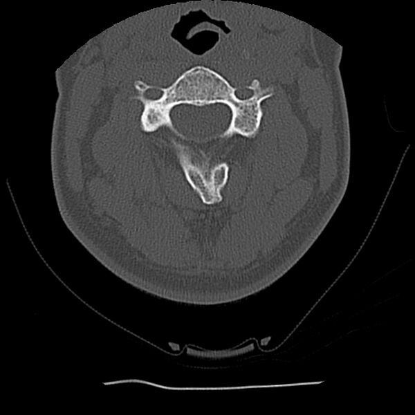 File:Normal trauma spine imaging (Radiopaedia 31753-32686 Axial bone window 28).jpg