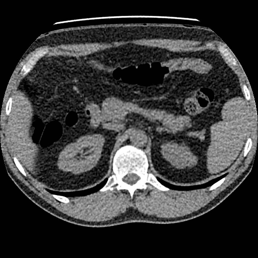 Obstructing ureteric calculus and ureteric anatomy (Radiopaedia 62730-71042 Axial non-contrast 17).jpg