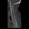 Occipital condyle fracture (Radiopaedia 31755-32691 Sagittal bone window 24).jpg