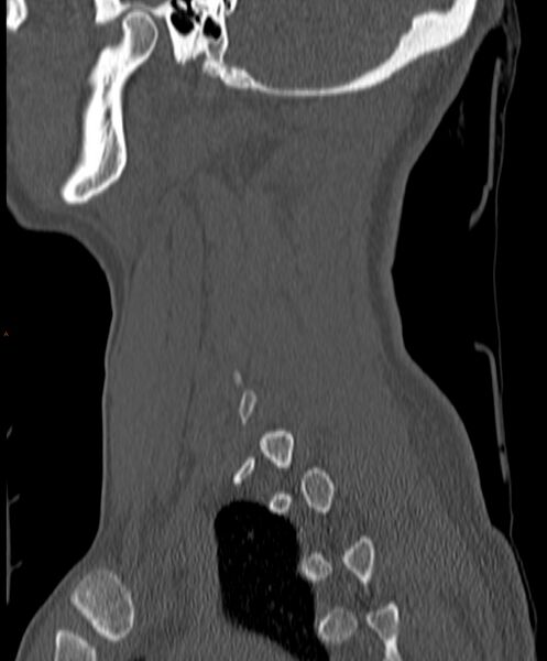 File:Occipital condyle fracture (Radiopaedia 61165-69056 Sagittal bone window 21).jpg