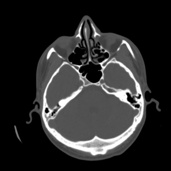 File:Occipital spur - asymptomatic (Radiopaedia 87753-104201 Axial bone window 45).jpg