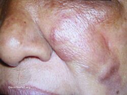 Mucormycosis skin near eyes and nose.[29]