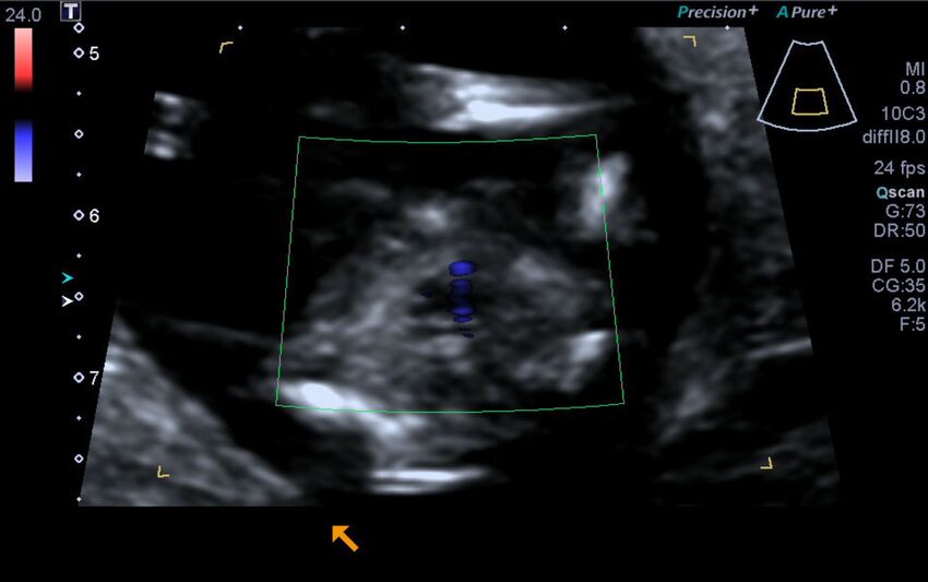 1st trimester nuchal-morphology ultrasound (Radiopaedia 44706-48477 Heart views cine with colour 173).jpg