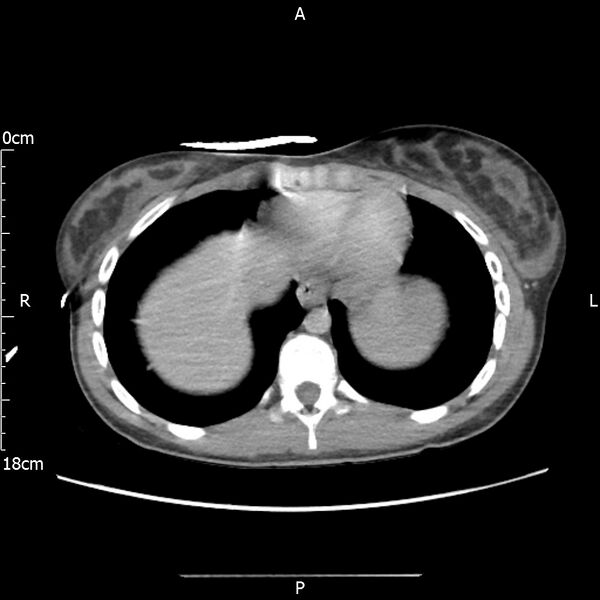 File:AAST grade IV kidney injury with CEUS follow-up (Radiopaedia 72353-82877 Axial C+ portal venous phase 5).jpg