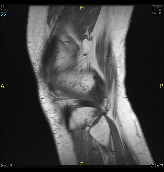 File:ACL mucoid degeration with cystic changes (Radiopaedia 48428-53341 Sagittal T1 20).jpg
