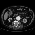 Abdominal aortic aneurysm (Radiopaedia 25855-26001 Axial C+ arterial phase 61).jpg
