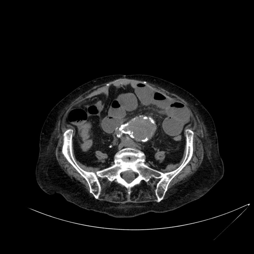 Abdominal aortic aneurysm - impending rupture (Radiopaedia 19233-19246 Axial non-contrast 87).jpg