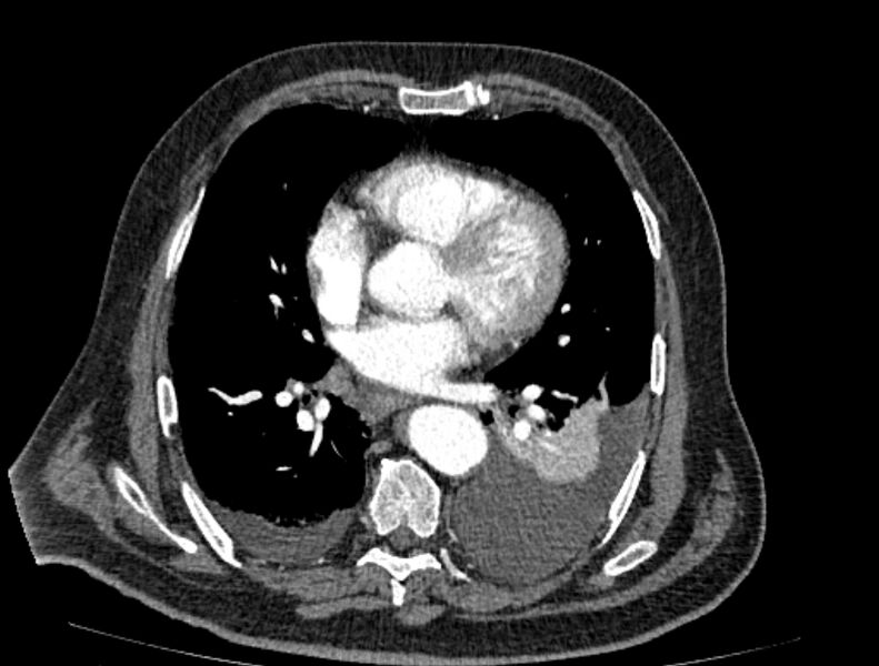 File:Abdominal aortic aneurysm rupture (Radiopaedia 54179-60362 Axial C+ arterial phase 12).jpg