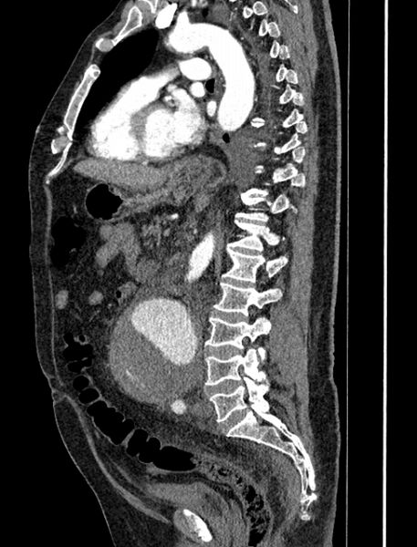 File:Abdominal aortic aneurysm rupture (Radiopaedia 54179-60362 Sagittal C+ arterial phase 24).jpg