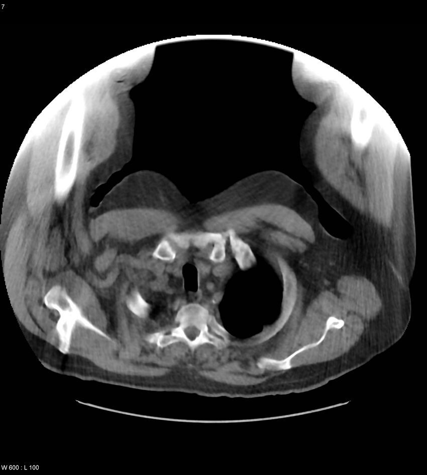Abdominal aortic aneurysm with intramural hematoma then rupture (Radiopaedia 50278-55631 Axial non-contrast 3).jpg