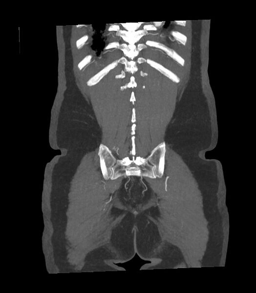 File:Abdominal aortic aneurysm with thrombus fissuration (Radiopaedia 46218-50618 Coronal C+ arterial phase 2).jpg
