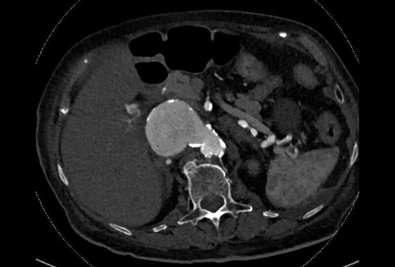 File:Abdominal aortic aneurysm with thrombus fissuration (Radiopaedia 73192-83919 Axial C+ arterial phase 40).jpg