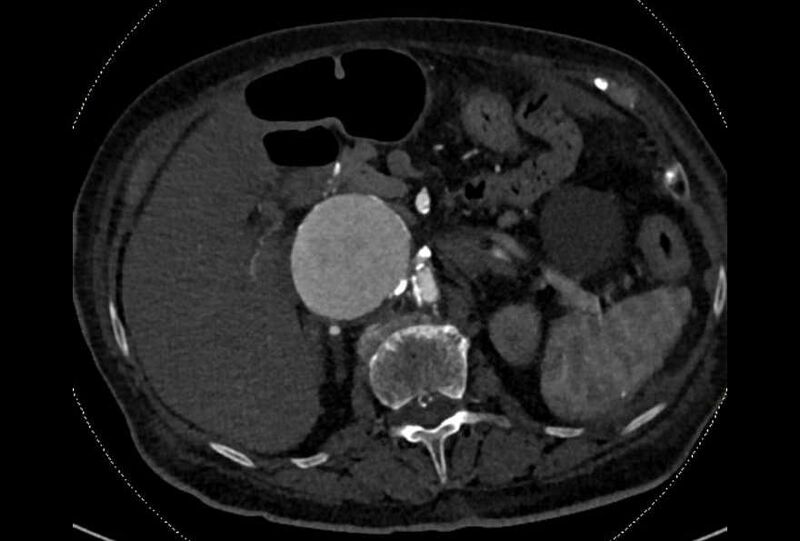 File:Abdominal aortic aneurysm with thrombus fissuration (Radiopaedia 73192-83919 Axial C+ arterial phase 44).jpg