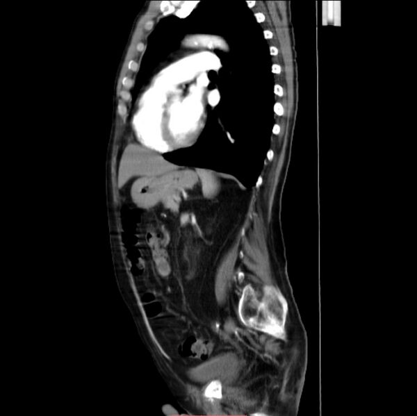 File:Abdominal aortic interposition tube graft and aneurysm thrombosis (Radiopaedia 71438-81857 Sagittal C+ arterial phase 11).jpg