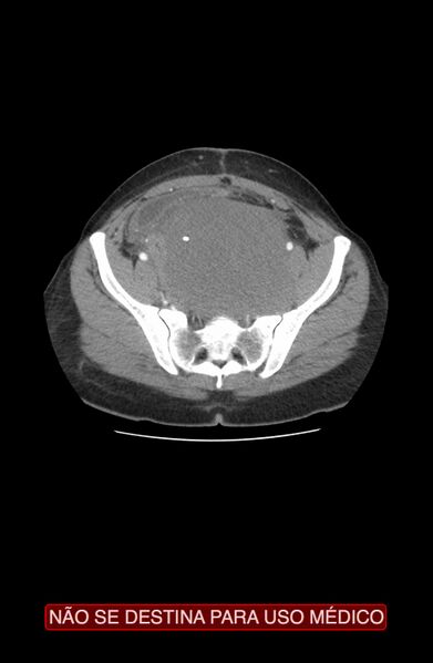 File:Abdominal desmoid tumor (Radiopaedia 44024-47540 Axial C+ arterial phase 35).jpg