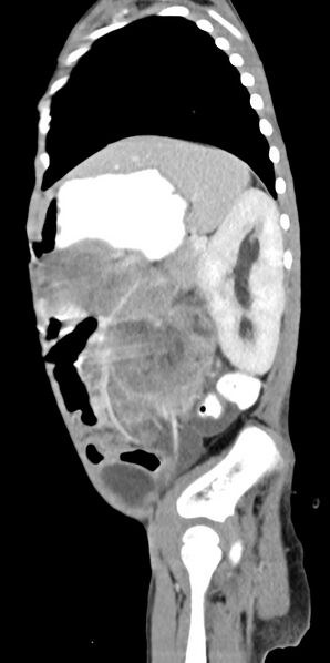 File:Abdominopelvic rhabdomyosarcoma (Radiopaedia 78356-90984 Sagittal C+ portal venous phase 27).jpg