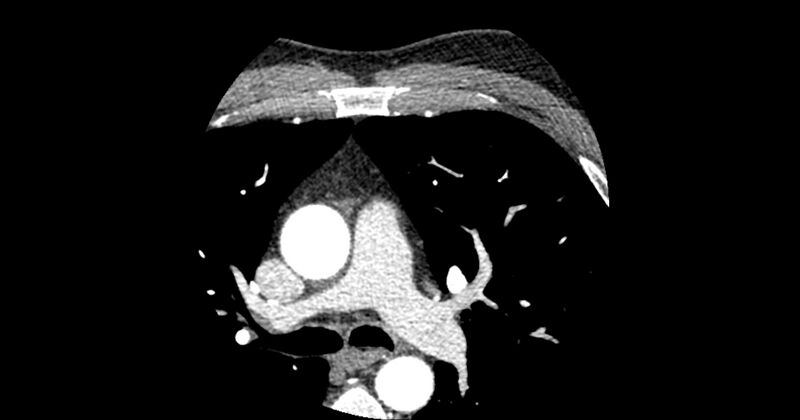 File:Aberrant left main coronary artery (ALMCA) arising from the right sinus with interarterial course (Radiopaedia 63251-71814 Axial C+ arterial phase 12).JPG