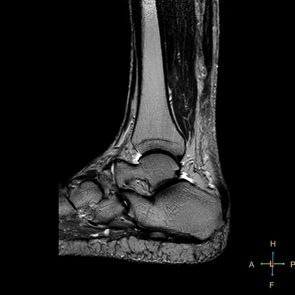 File:Achilles tendon complete tear (Radiopaedia 22834-22854 Sagittal T2 7).jpg