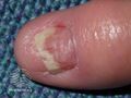 Acitretin nail thinning (DermNet NZ treatments-acitretin-nail-1).jpg