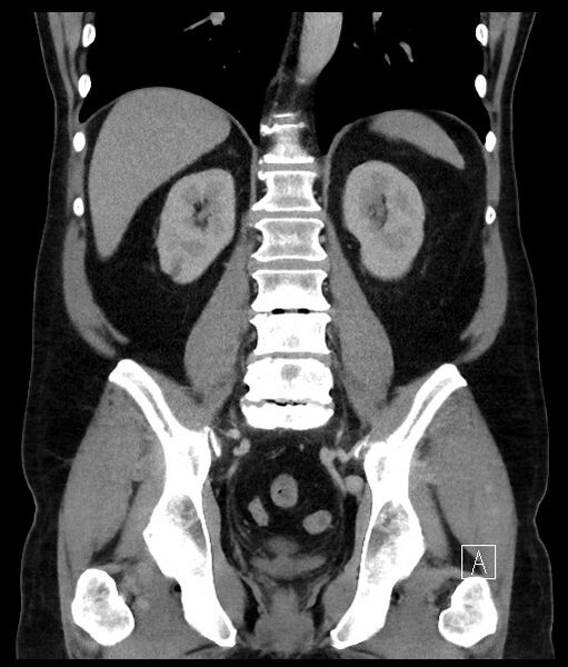 File:Acute-on-chronic pancreatitis (Radiopaedia 67286-76656 Coronal C+ portal venous phase 51).jpg