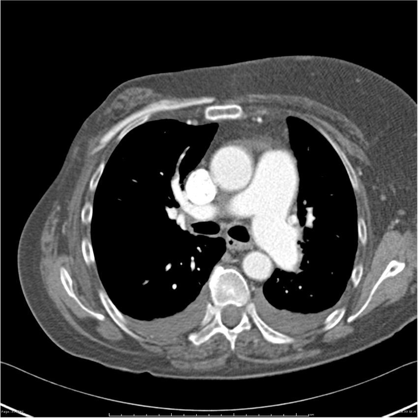 Acute-on-chronic pulmonary emboli (Radiopaedia 27925-28169 C+ CTPA 33).jpg