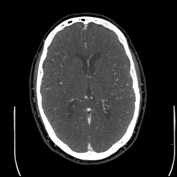 File:Acute A3 occlusion with ACA ischemic penumbra (CT perfusion) (Radiopaedia 72036-82527 Axial C+ arterial phase thins 62).jpg