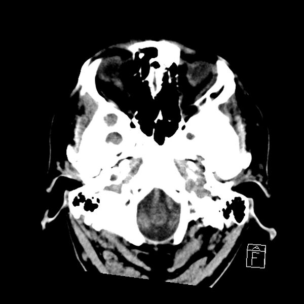 File:Acute P1 occlusion with PCA ischemia penumbra (CT perfusion) (Radiopaedia 72084-82586 Axial non-contrast 4).jpg