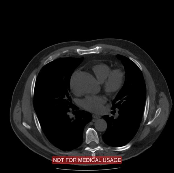 File:Acute aortic dissection - Stanford type A (Radiopaedia 40661-43285 Axial non-contrast 32).jpg